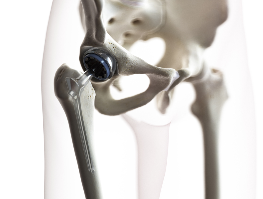 Coxarthrose