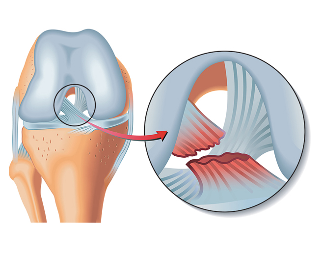 Ligament croisés