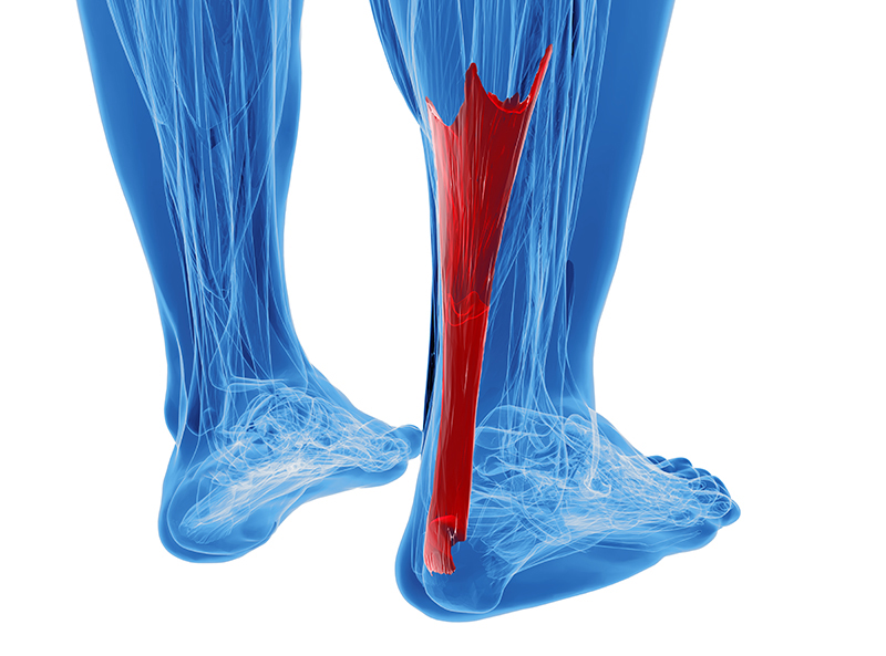 Rupture du tendon d'achille