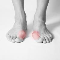 Hallux valgus