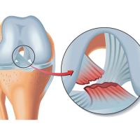 Ligament croisés